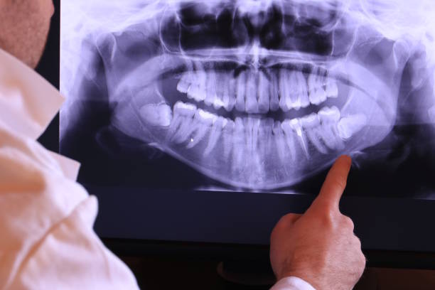 Best Knocked-Out Tooth (Avulsed Tooth) Treatment in Williston, ND